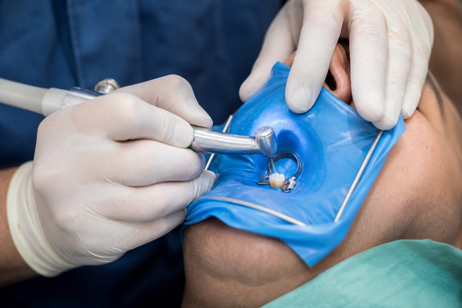 Clinical endodontic procedure in progress